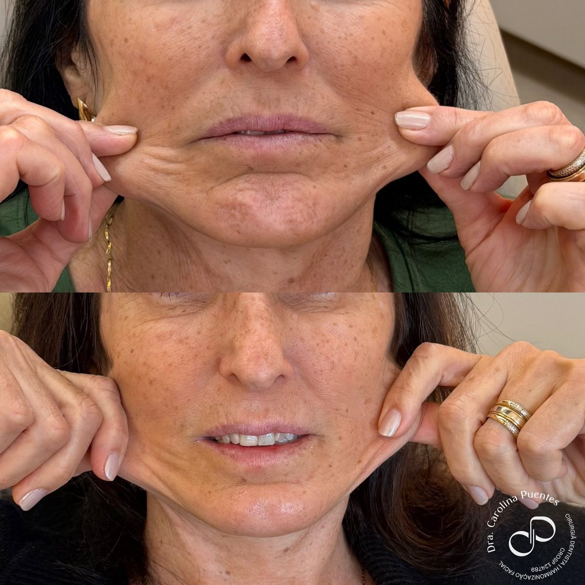 Antes e depois — bioestimulador de colágeno (Radiesse) em Bauru/SP