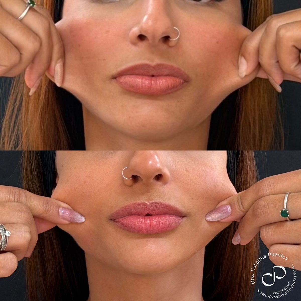Antes e depois — bioestimulador de colágeno (Radiesse) e ultrassom microfocado em Bauru/SP