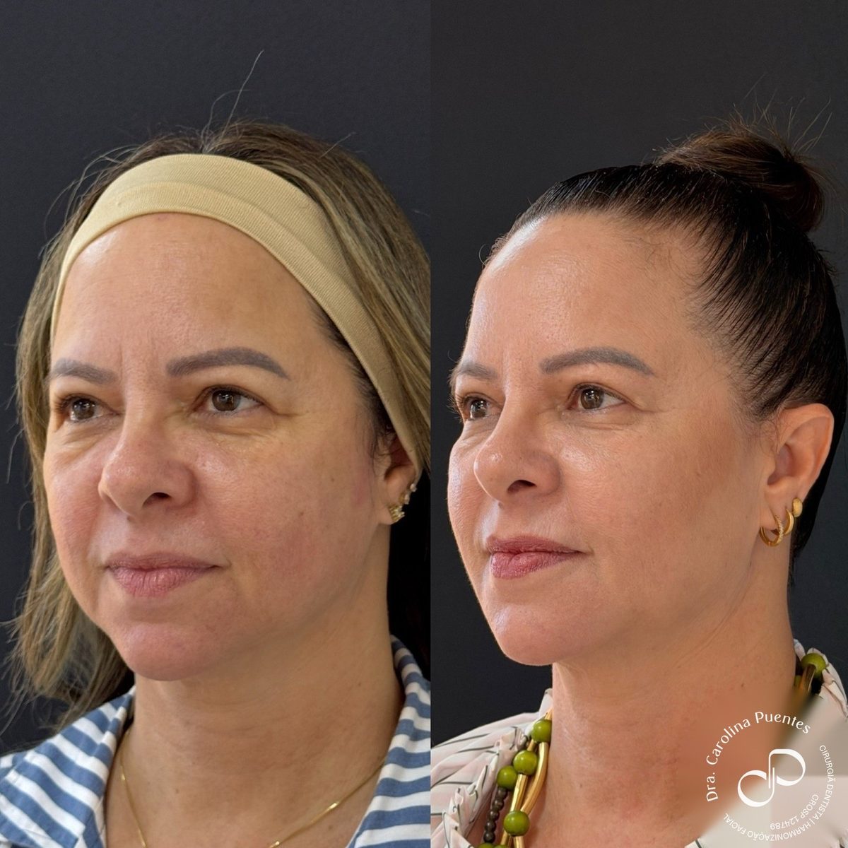 Antes e depois — full face (têmpora, malar, olheira, labial, mento), bioestimulador (Radiesse) e ultrassom microfocado em Bauru/SP