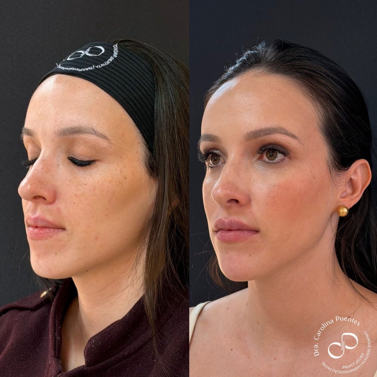 Antes e depois — full face (têmpora, malar, mandíbula, labial e mento) em Bauru/SP, caso 1