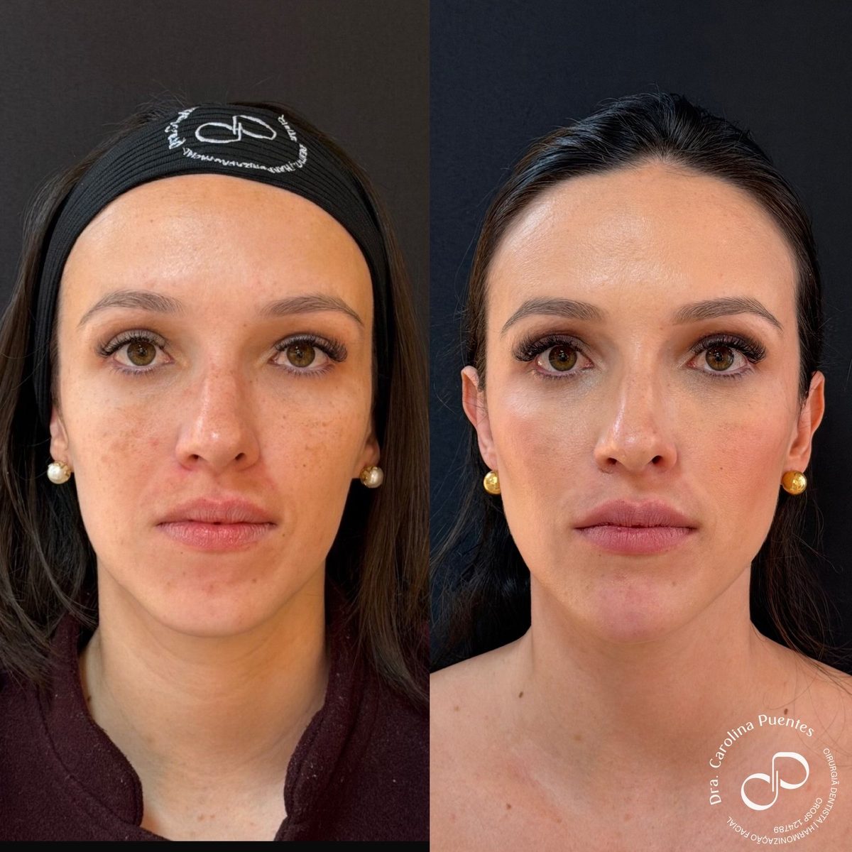 Antes e depois — full face (têmpora, malar, mandíbula, labial e mento) em Bauru/SP, caso 2