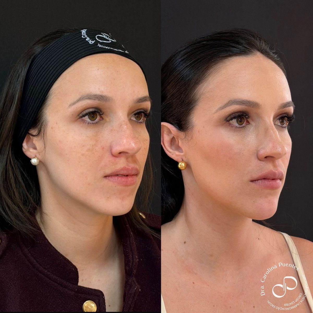 Antes e depois — full face (têmpora, malar, mandíbula, labial e mento) em Bauru/SP, caso 3