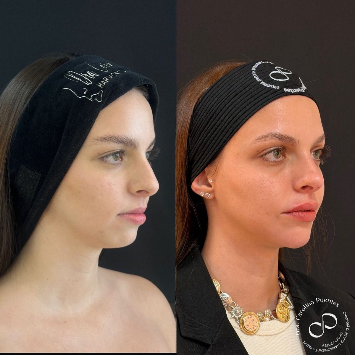 Antes e depois — full face (têmpora, malar, nariz, boca e mento) em Bauru/SP