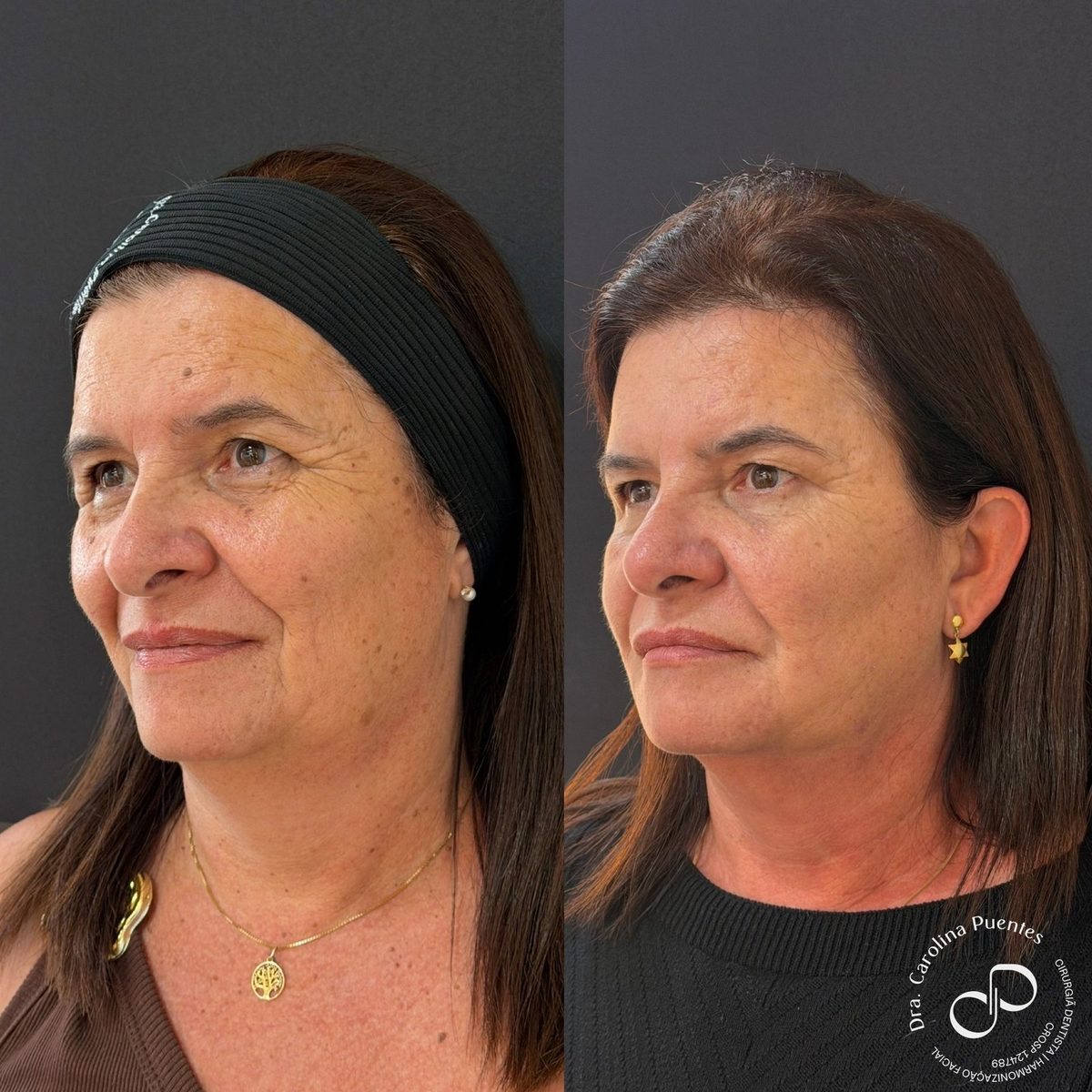 Antes e depois — full face (têmpora, malar, nariz, mento e mandíbula) em Bauru/SP