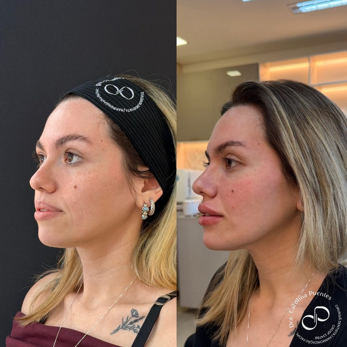 Antes e depois — full face (têmpora, malar, olheira, labial, mento e mandíbula) em Bauru/SP