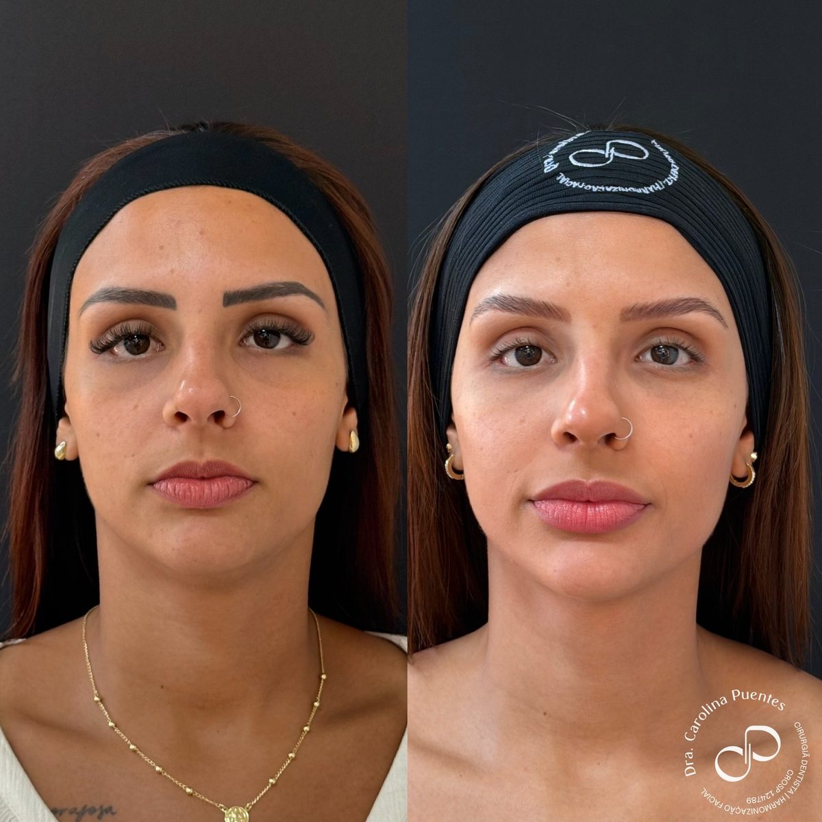 Antes e depois — preenchimento de têmpora, malar, olheira, nariz, lábio e mento em Bauru/SP, outro caso