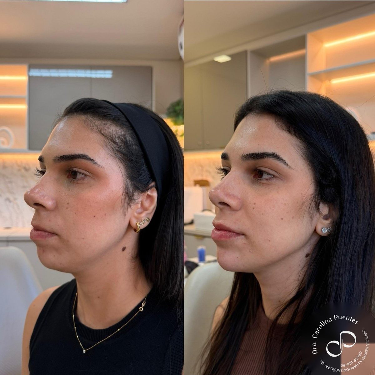 Antes e depois — preenchimento labial e de mento em Bauru/SP