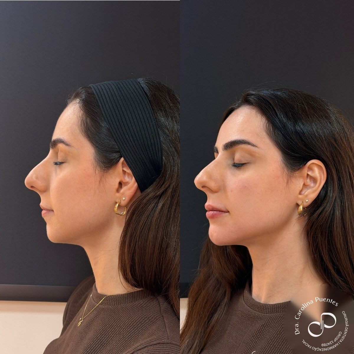 Antes e depois — preenchimento labial e de mento em Bauru/SP, outro caso