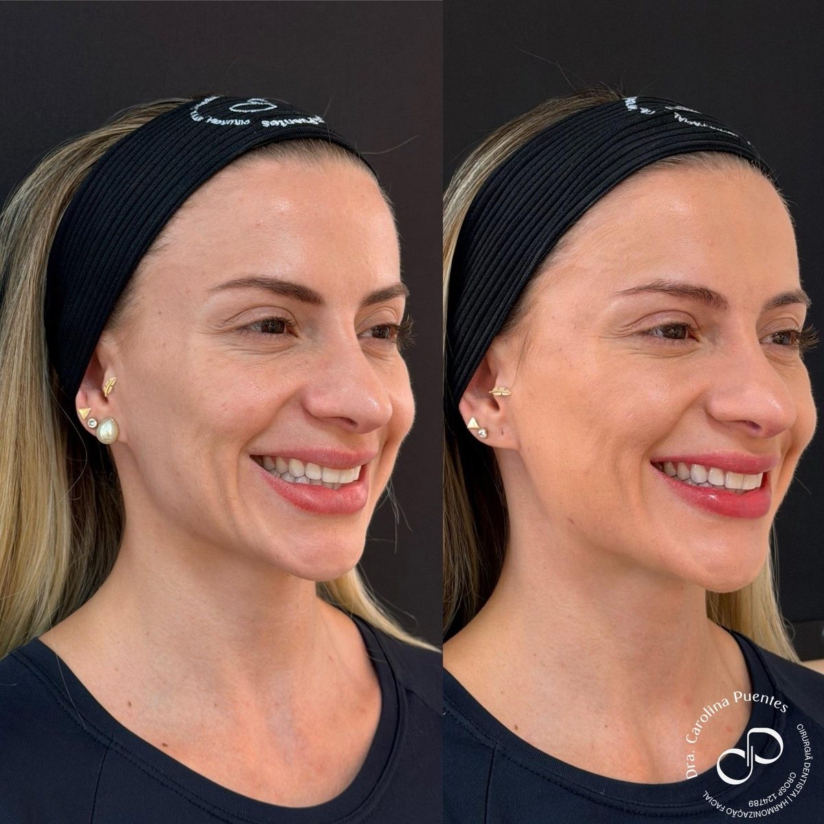 Antes e depois — preenchimento de têmpora e bioestimulador de colágeno (Sculptra) em Bauru/SP