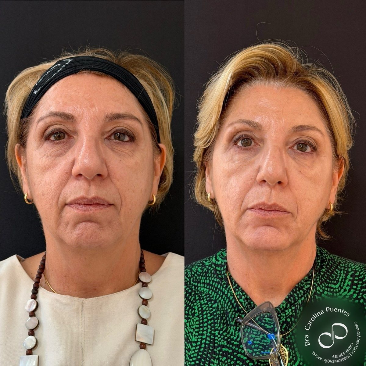 Antes e depois — preenchimento de têmpora, malar e mento em Bauru/SP