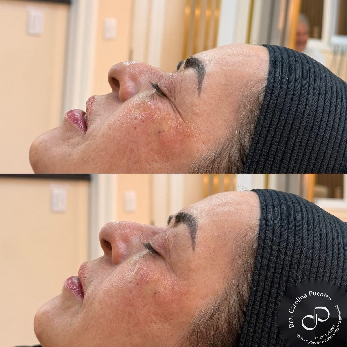Antes e depois — rinomodelação com preenchimento de ácido hialurônico em Bauru/SP