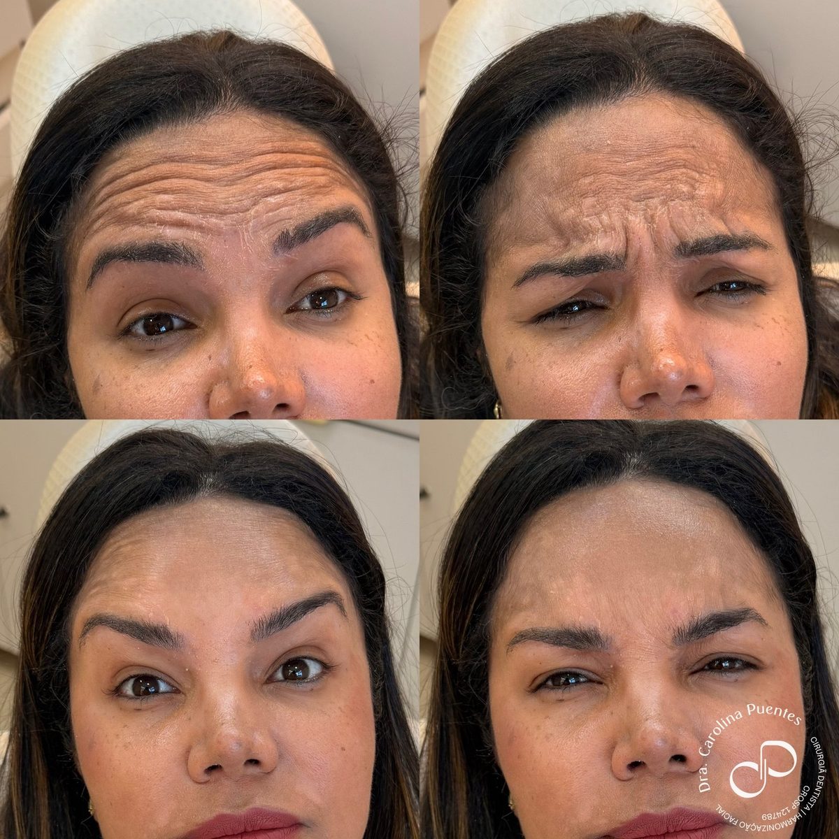 Antes e depois — toxina botulínica (Botox) em Bauru/SP