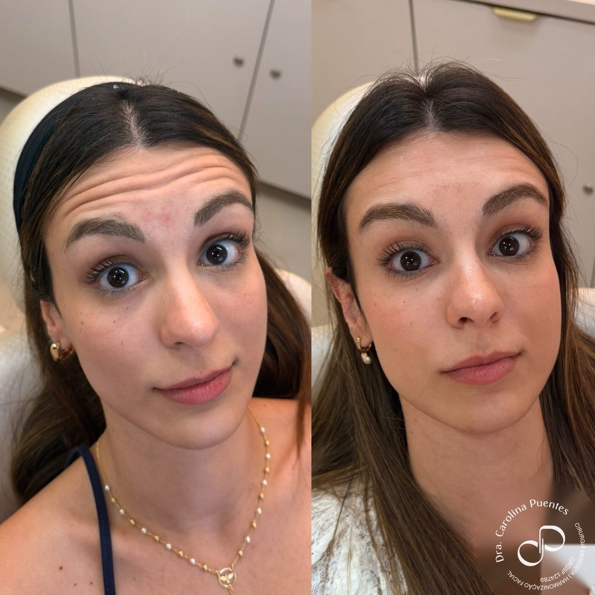 Antes e depois — toxina botulínica e preenchimento de olheira e lábio em Bauru/SP